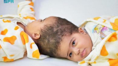 بتوجيهات خادم الحرمين : نجاح عملية فصل التوأم الملتصق الإريتري "أسماء وسمية" 4 SVLSv6FshVrOcmETLVMIdLOOsHUOLXv65jiPtrEK