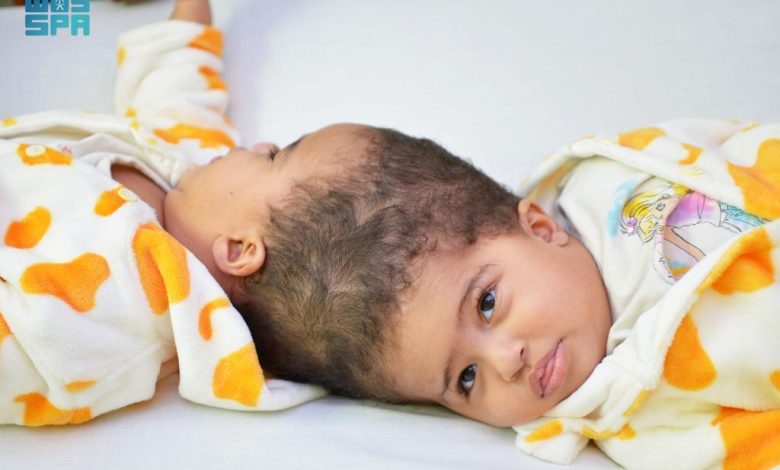 بتوجيهات خادم الحرمين : نجاح عملية فصل التوأم الملتصق الإريتري "أسماء وسمية" 1 SVLSv6FshVrOcmETLVMIdLOOsHUOLXv65jiPtrEK